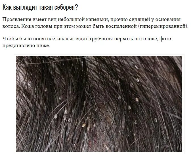 Почему у ребенка перхоть. Трубчатая перхоть на волосах головы.