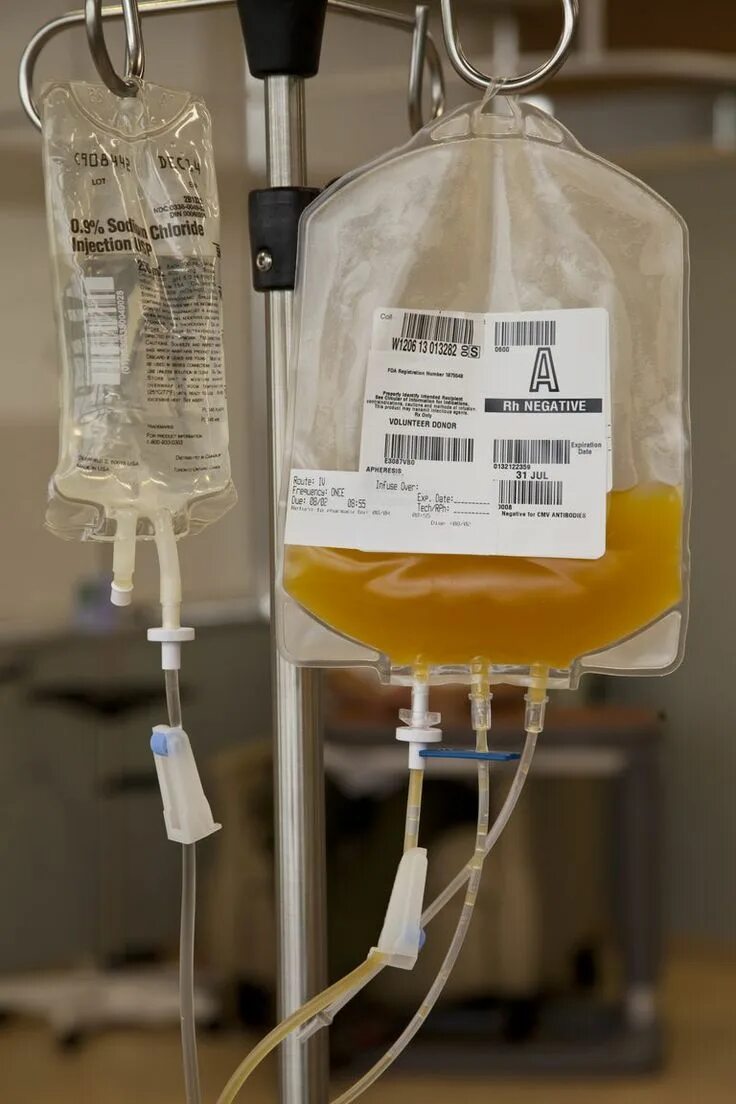 Гемотрансфузия плазмы крови. Переливание тромбоцитов. Капельница для переливания крови.