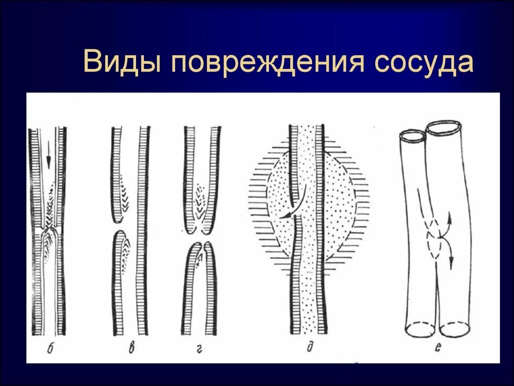 Разрыв кровеносного сосуда. Повреждение кровеносных сосудов. Типы повреждения сосудов.