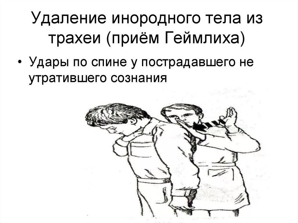 Приемы удаления инородных тел. Удаление инородного тела. инородные тела трахеи и бронхов у детей. инородные тела из трахеи прием.