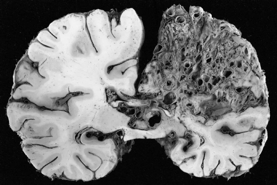 Brain disease. Прионы губчатая энцефалопатия. Болезнь Крейтцфельдта-Якоба. Болезнь Крейтцфельдта-Якоба гистология.