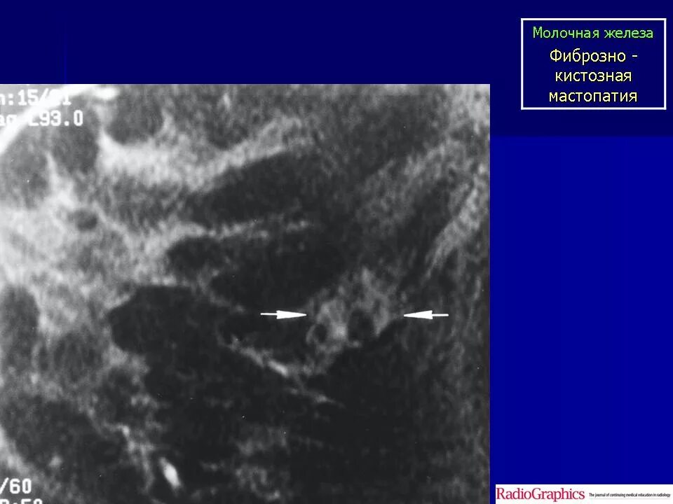 Фиброма в груди. Галактоцеле на маммографии. Фиброматоз молочной железы на УЗИ. Кистозная мастопатия УЗИ. Фиброзно-кистозная мастопатия молочных желез на УЗИ.