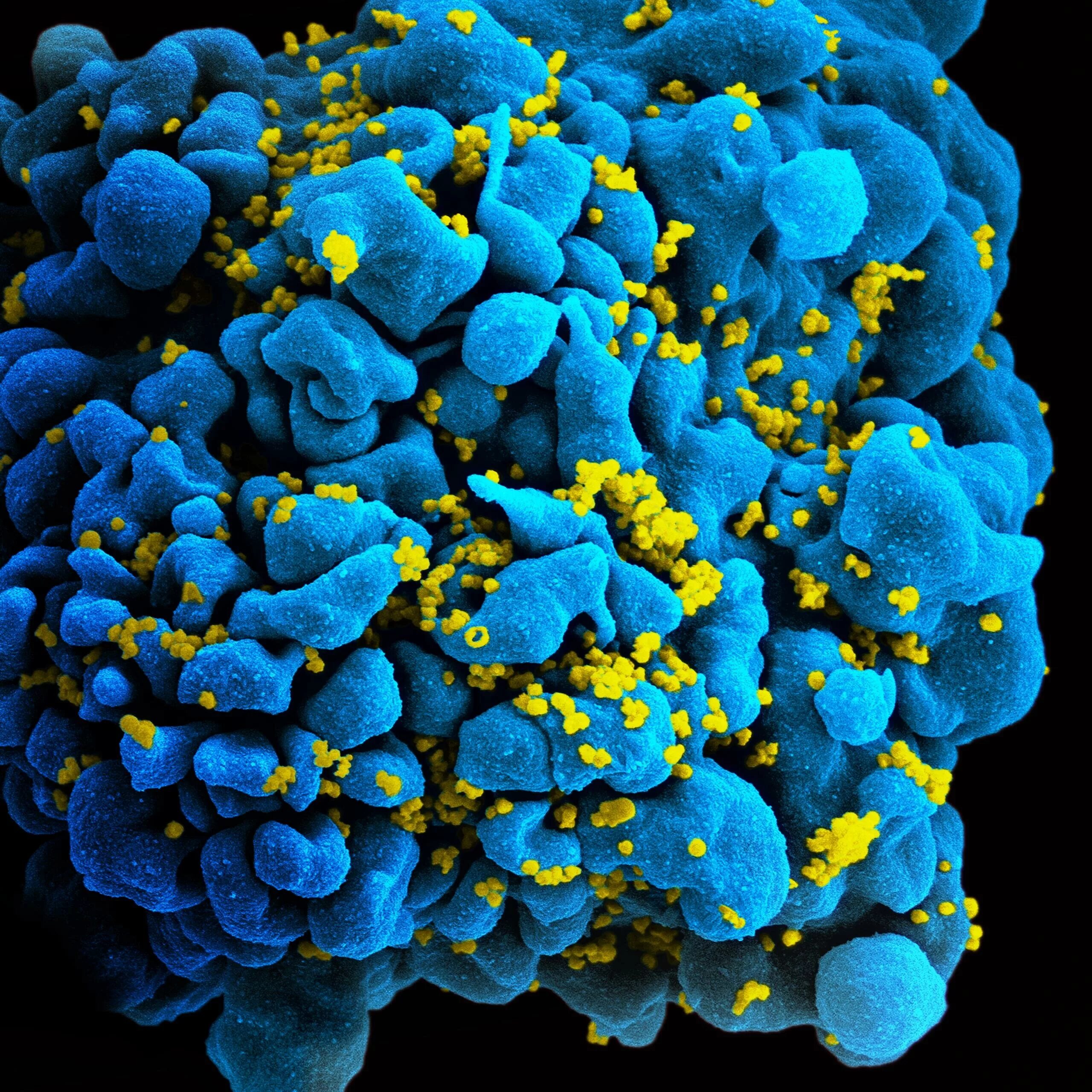 Вирус иммунодефицита под микроскопом. СПИД поражает т-лимфоциты. Вирус иммунодефицита человека (Human Immunodeficiency virus).