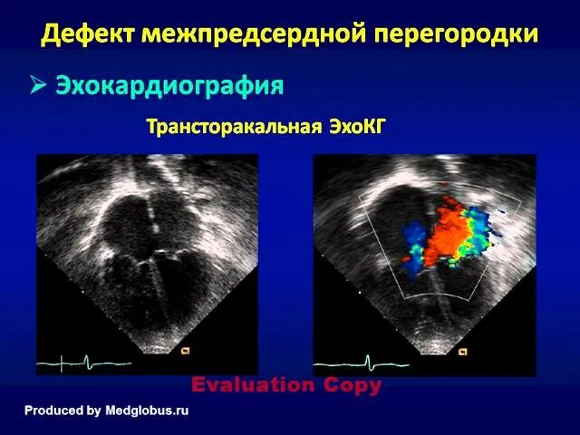 Аневризма перегородки у ребенка. Дефект межпредсердной перегородки ЭХОКГ. Пороки межпредсердной перегородки ЭХОКГ. Дефект межпредсердной перегородки эхокардиография.