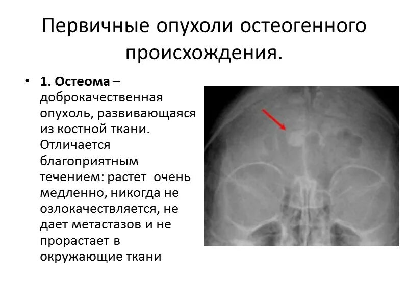 Доброкачественные опухоли костей. Остеоид бедренной кости. Доброкачественная остеома. Остеома бедренной кости рентген. Доброкачественная остеома.