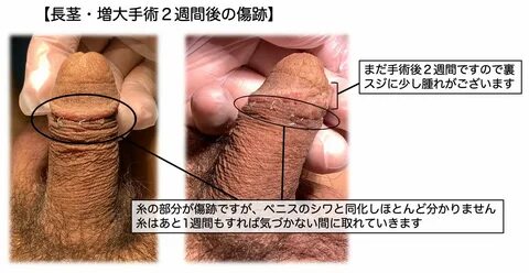 こ の 画 像 は 手 術 を 行 っ て ２ 週 間 後 の 患 者 様 の 傷 跡 で す. 