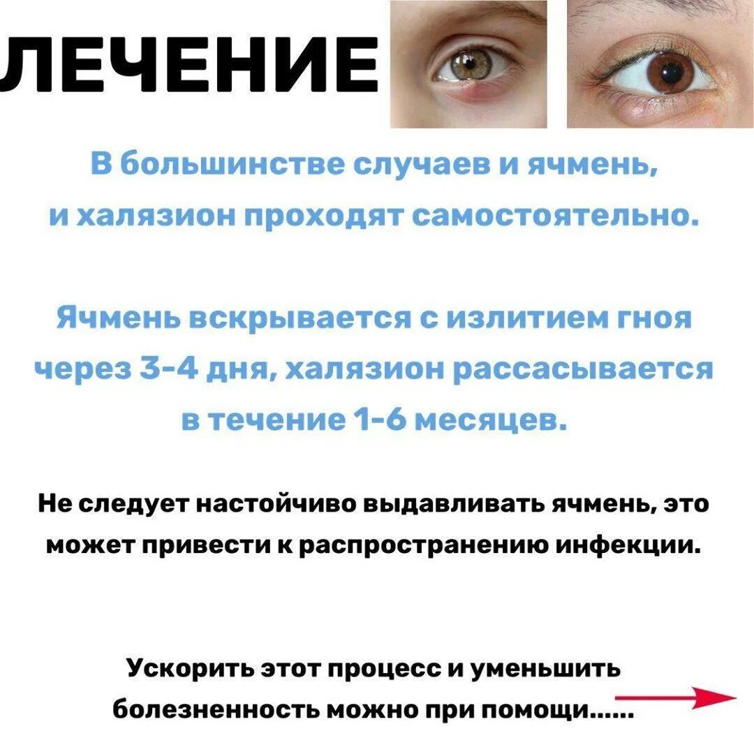 Ячмень что делать в домашних условиях. Воспаление глаза ячмень. Ячмень на глазу стадии развития.