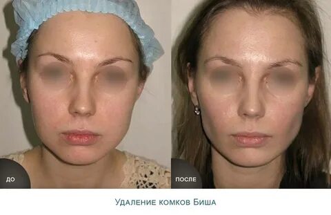 Где находятся комки биша на лице