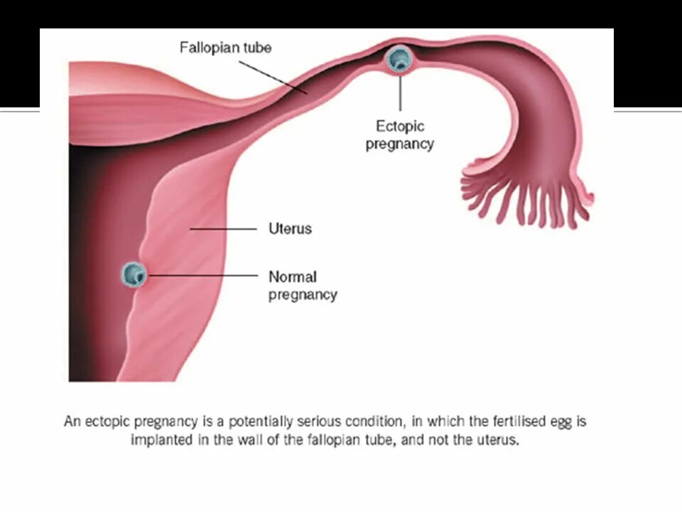 Беременность после внематочной отзывы