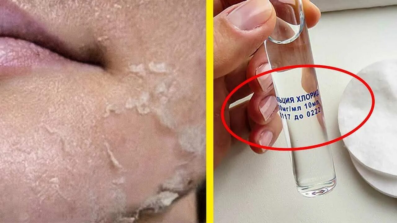 Скраб хлористым кальцием. Кальция хлорид для пилинга лица. Кальция хлорид для лица пилинг. Голливудский пилинг с хлористым кальцием. Кальция хлорид для пилинга лица.