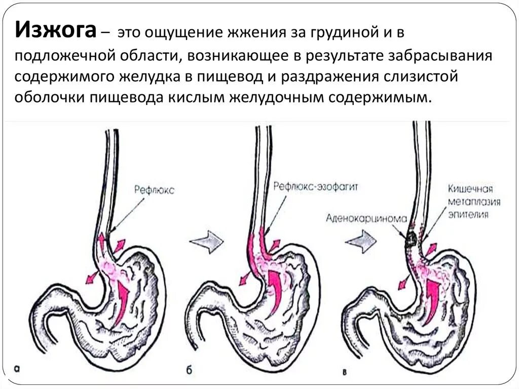 Почему горит желудок