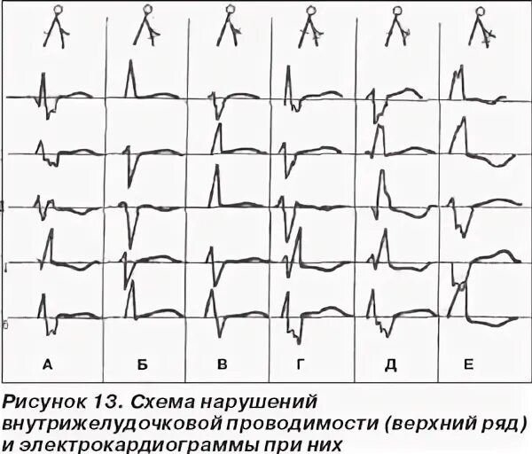 Что такое нарушение внутрижелудочковой проводимости