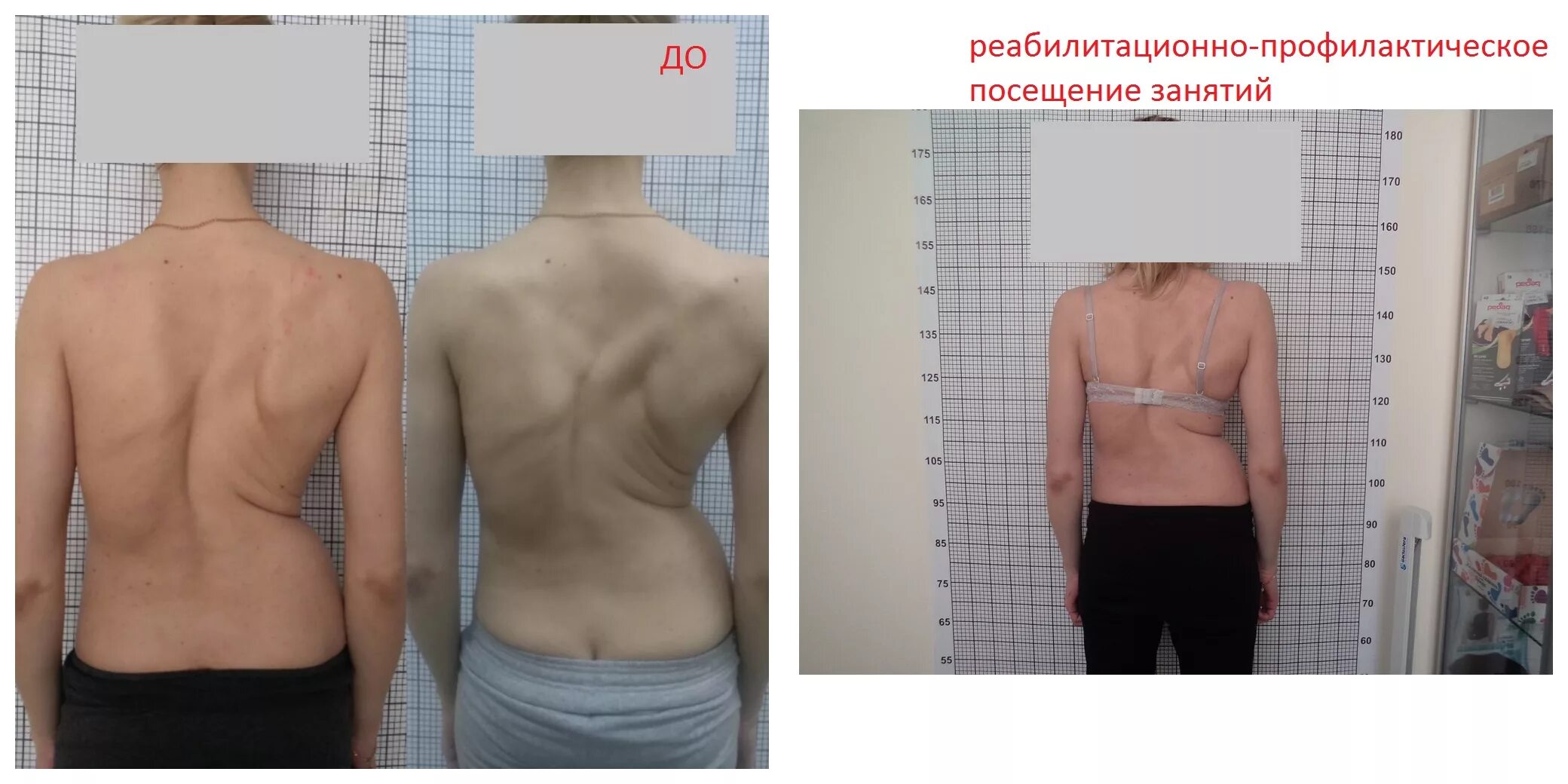 исправить сколиоз 3 степени. корсет шено s образный сколиоз. сколиотическая деформация грудной клетки. степени сколиоза позвоночника по градусам у детей. диспластический сколиоз 2 степени.