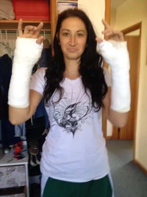 Arm casting. Double long arm cast. arm cast lac women. long arm cast woman.