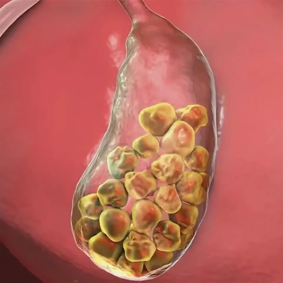 Застой в желчном пузыре симптомы. Застойные явления в желчном пузыре. Застойные процессы в желчном пузыре симптомы.