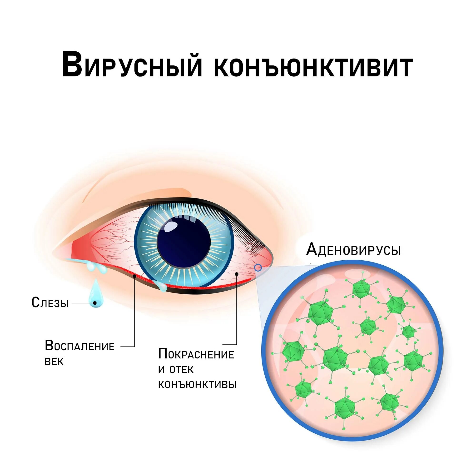 Конъюнктивит какие симптомы. Аденовирусная инфекция конъюнктивит. Клинические проявления аденовируса. Конъюнктивит при аденовирусной инфекции. Аденовирусная инфекция проявления.