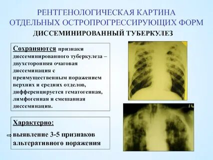 Туберкулез пример