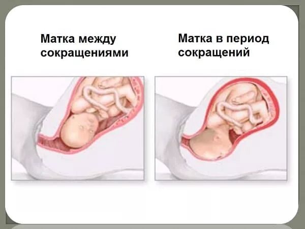 Гипертонус Матки Можно Заниматься Сексом