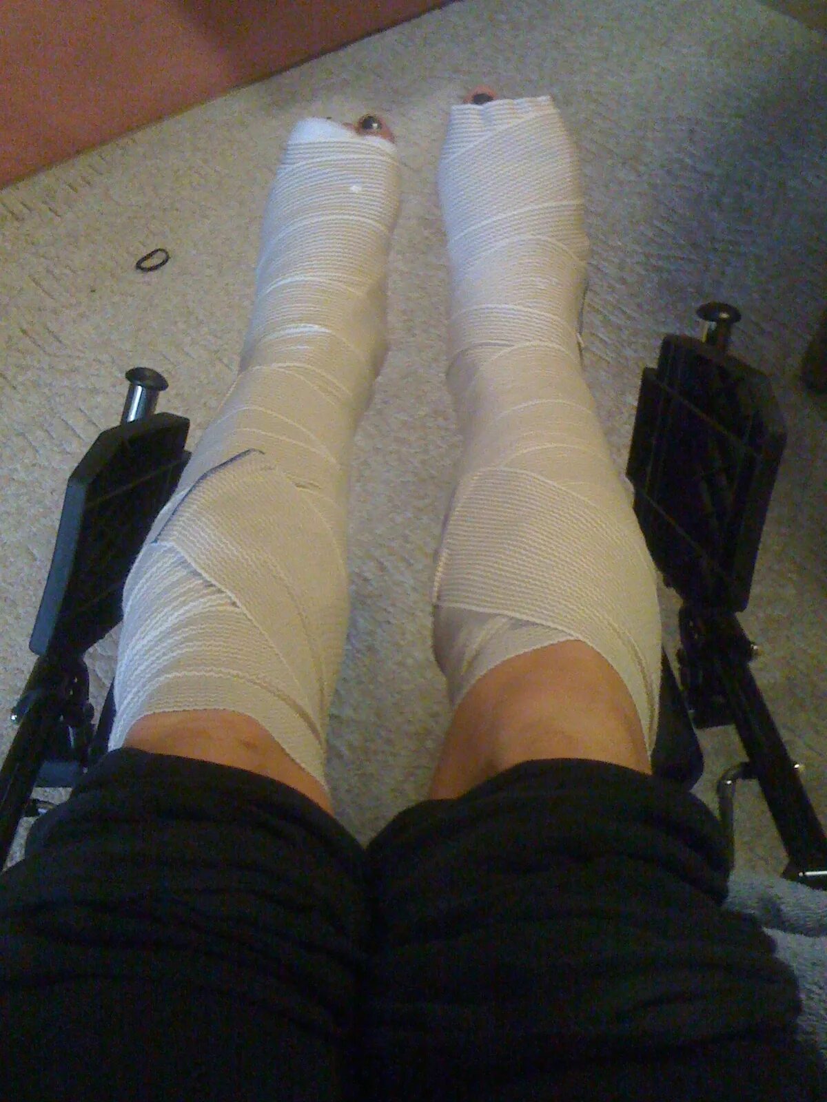 Разрисованный гипс на ноге. Резиновый гипс на ногу. Leg Cast.