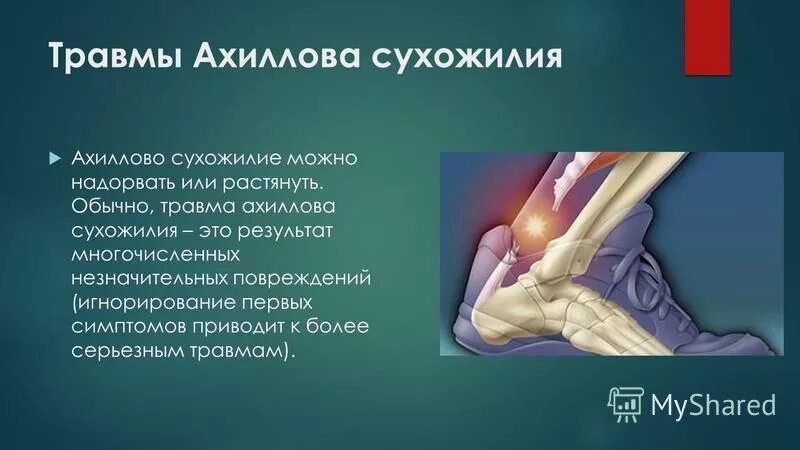 Где находится ахиллесова пята. Где находится ахиллесова пята. Ахиллесова пята в медицине. Где находится ахиллесова пята. Ахиллесова пята где.