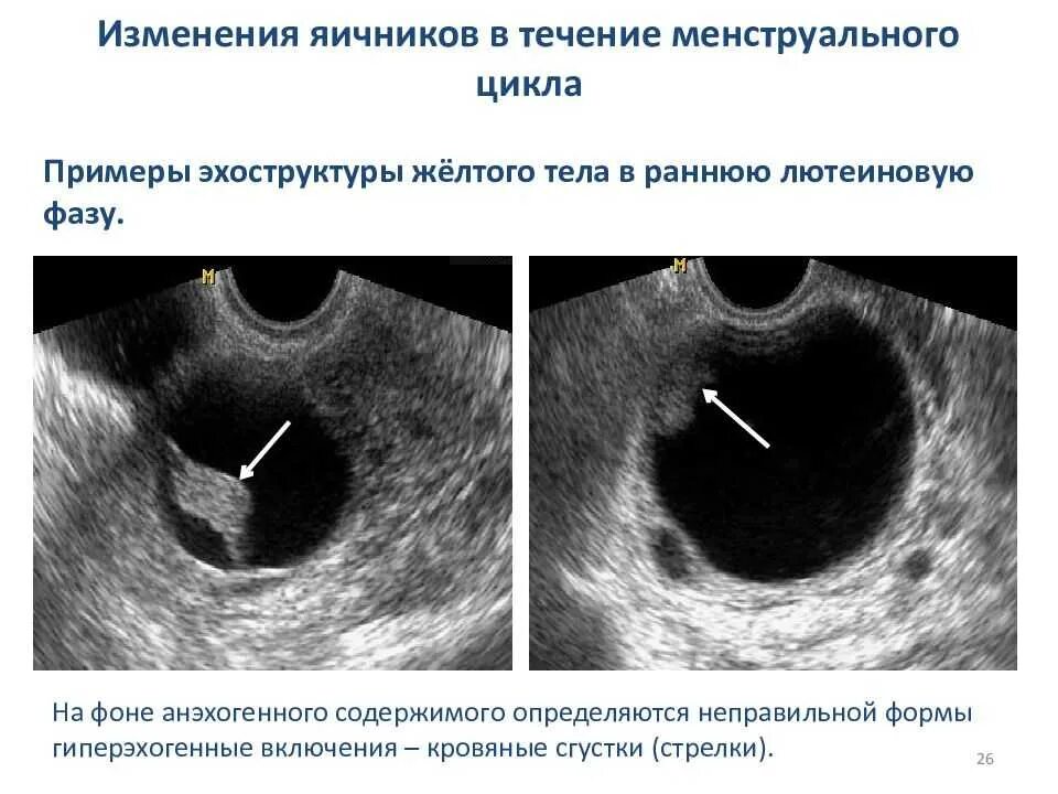 Тянет яичник при беременности на ранних. Тянет яичник при беременности на ранних