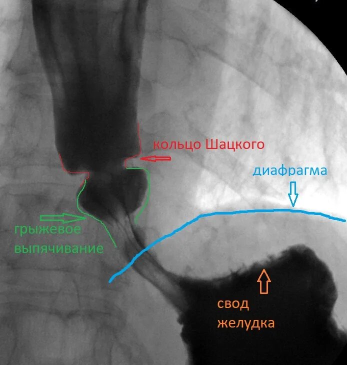 Пищевод шацкого. Фиброзное кольцо Шацкого. Кольцо Шацкого в пищеводе. Кольцо Шацкого рентген. Кольцо Шацкого нижней трети пищевода.