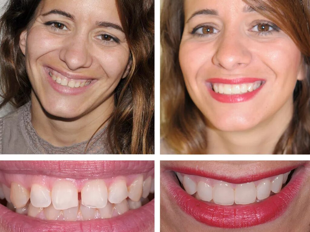 Красивые зубы до и после. Изменение формы зубов