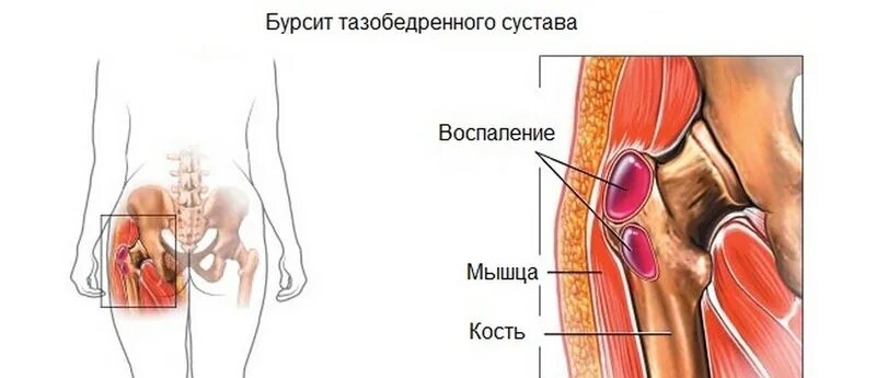 Вертельный бурсит тазобедренного. Боль в обл тазобедренного сустава. Бурсит тазобедренного сустава боль. Бурсит трохантерит тазобедренного сустава.