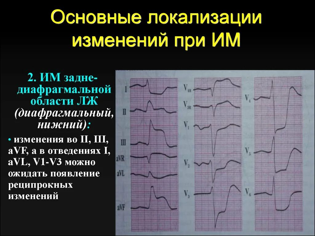 Правограмма на ЭКГ. Левограмма на ЭКГ. Левограмма и правограмма на ЭКГ. ЭКГ при правограмме. Неспецифические изменения нижней стенки