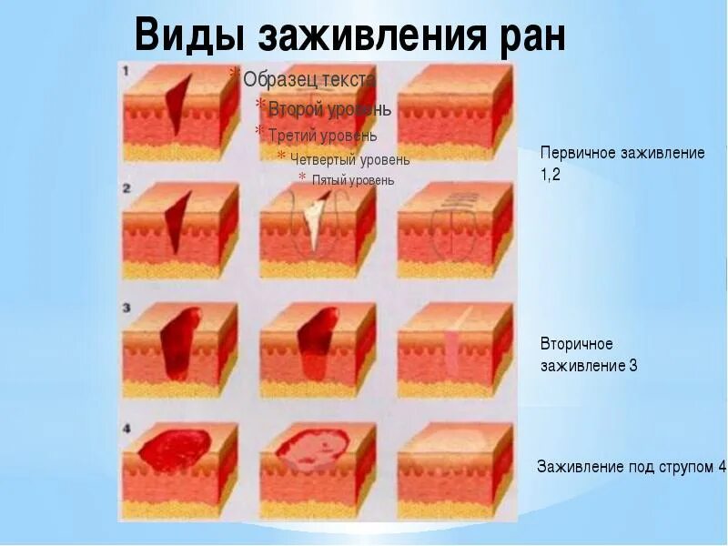 Заживление трещины в заднем. Этапы заживления послеоперационных РАН. Этапы заживления резаной раны. Фазы процесса заживления РАН. Стадии заживления РАН кожи.