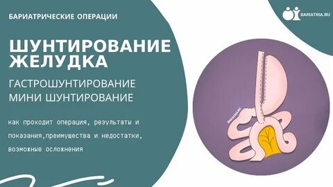 Сколько времени длится операция шунтирования