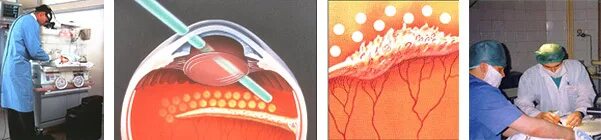 Ретинопатия недоношенных лазеркоагуляция. Лазеркоагуляция сетчатки при ретинопатии недоношенных. Панретинальная лазерная коагуляция. Отслойка сетчатки операция. Лазерная коагуляция после операции