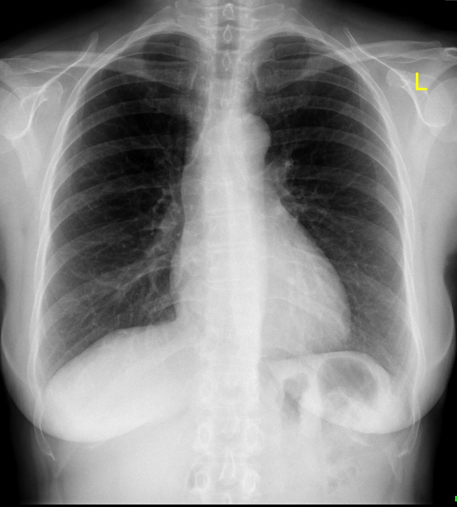 Source x rays