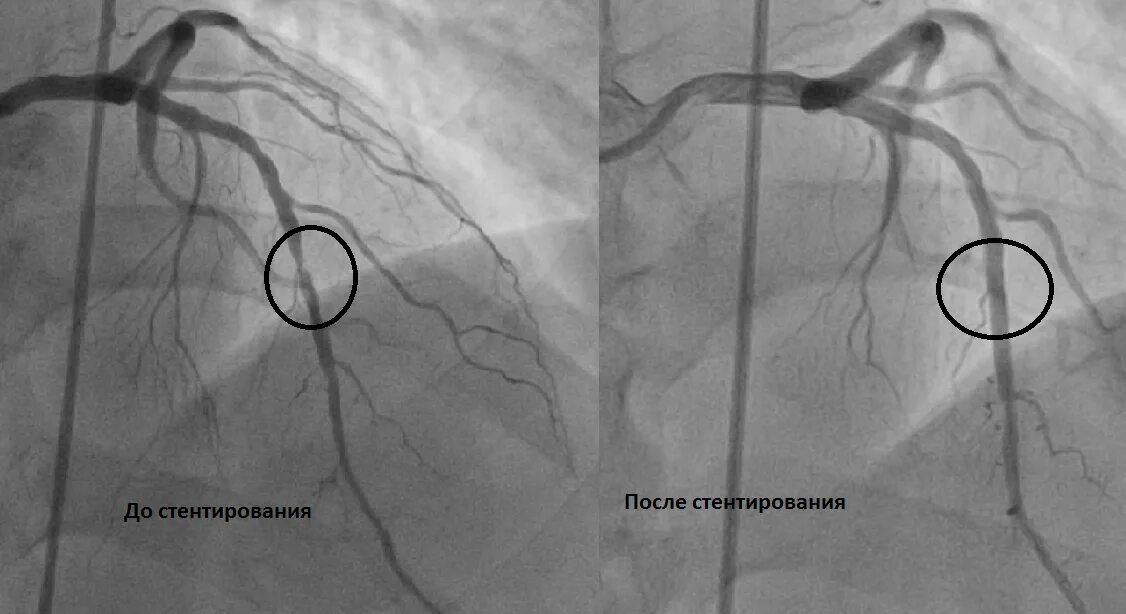Стентирование коронарных артерий схема. Коронарография сосудов стентирование. Операция коронарография стентирование. Шунтирование сосудов сердца стент.