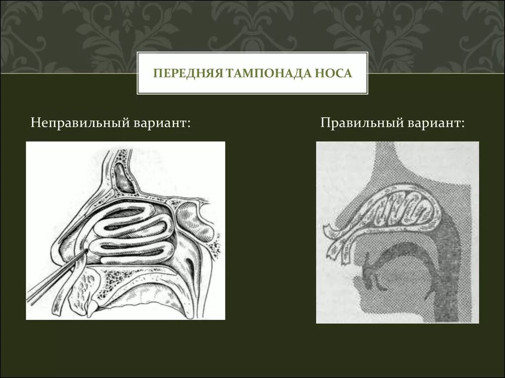 Заднее носовое кровотечение. Тампонада полости носа алгоритм. Тугая тампонада носовых ходов. Инструменты для тампонады носа. Носовое кровотечение передняя тампонада.