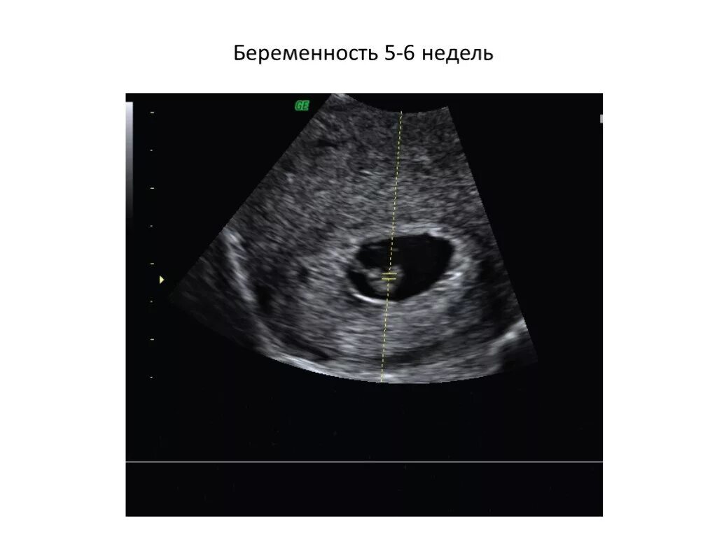 УЗИ 6 недель беременности. 5-6 Недель беременности фото плода на УЗИ. 6 недель учиться