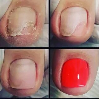 Гиперкератотический онихолизис 