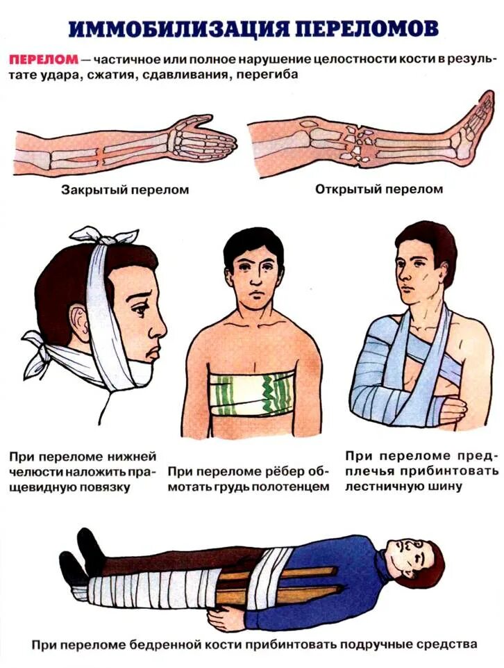 Оказание первой помощи при различных переломах. Иммобилизация конечности при переломе. первая помощь при переломах. первая помощь при перел. оказание первой помощи при переломах костей.