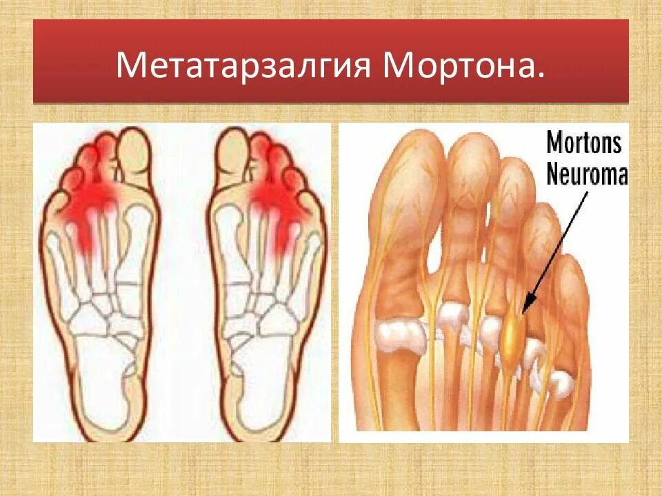 Мортоновская метатарзалгия. Метатарзалгия поперечное плоскостопие. Метатарсалгия Моргана. Метатарзалгия Мортона стопы что это такое.