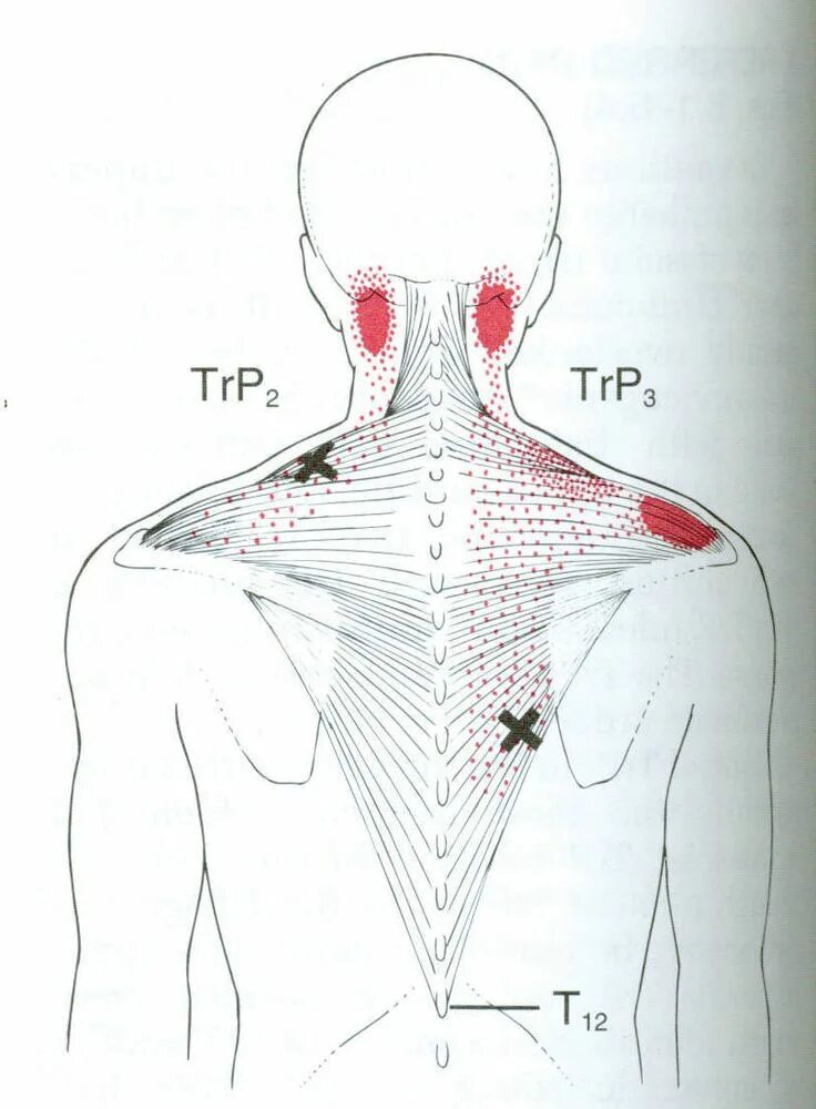 Триггерные точки поясницы. Мышцы диафрагмы триггерные точки. Триггерные точки схема расположения. Триггерная точка 4. Триггерные точки на спине схема.