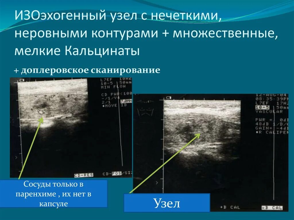 Узел в простате. Изоэхогенный узел щитовидной. Изоэхогенный узел щитовидной железы на УЗИ. Кальцинат щитовидной железы УЗИ. УЗИ щитовидной железы микрокальцинаты.