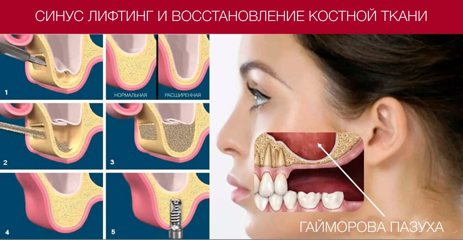 Синуслифтинг открытый. Синус-лифтинг (в зависимости от метода). Синус-лифтинг (костная пластика, остеопластика). Остеотомный синус лифтинг.