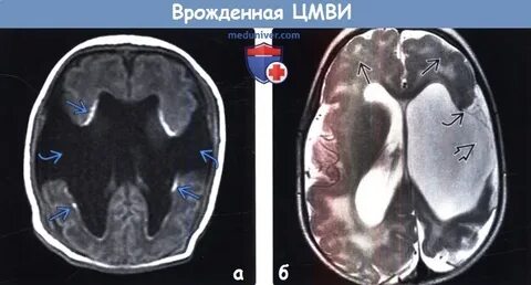 Врожденная цитомегаловирусная инфекция тест