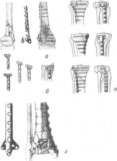 Клюкало. Метафизарная пластина для остеосинтеза. Рыбинский остеосинтез мыщелковая пластина плеча. Накостный остеосинтез лопатки.
