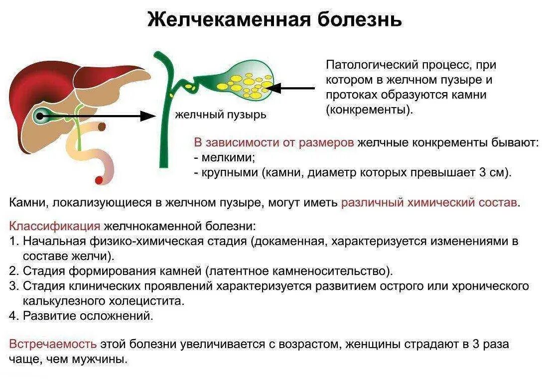 Как проверить работу желчного пузыря. Желчекаменная болезнь(жкб) симптомы. причины образования желчных камней. симптомы, характерные для поражения желчного пузыря. желчнокаменная болезнь (жкб).