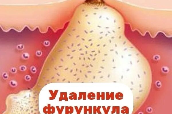 Как выглядит фурункул после вскрытия Удаление фурункула: как удалить фурункул хирургическим путем