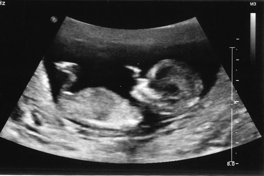 Ребенок 11 недель узи. Беременность 25 недель фото плода на УЗИ. УЗИ 1 скрининг 12 недель. Скрининг 13 недель беременности фото плода на УЗИ. УЗИ плода 12,5 недель беременности.