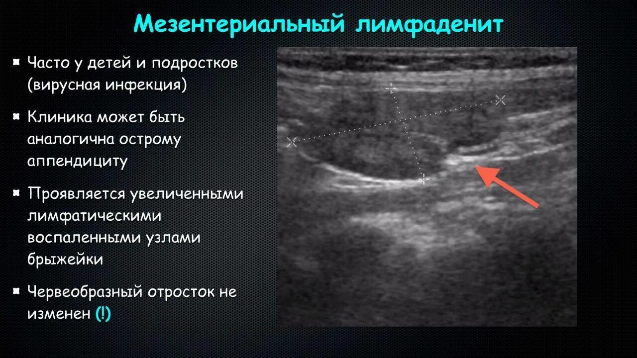 Кальцинаты в лимфоузлах. Мезентериальный лимфаденит кт. Мезентериальные лимфатические узлы. Мезентериальные лимфатические узлы увеличены. УЗИ лимфоузлов брюшной полости.