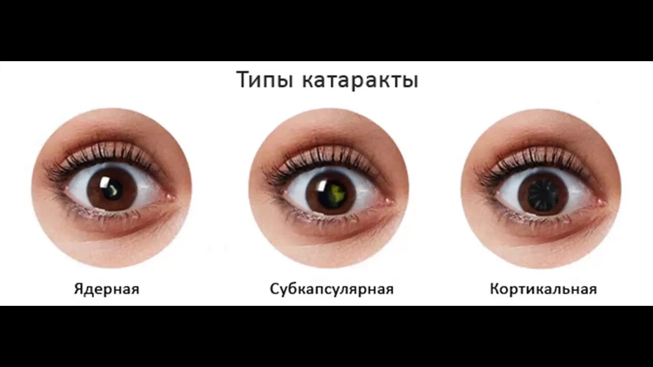 Что такое катаракта и как ее лечить? - YouTube