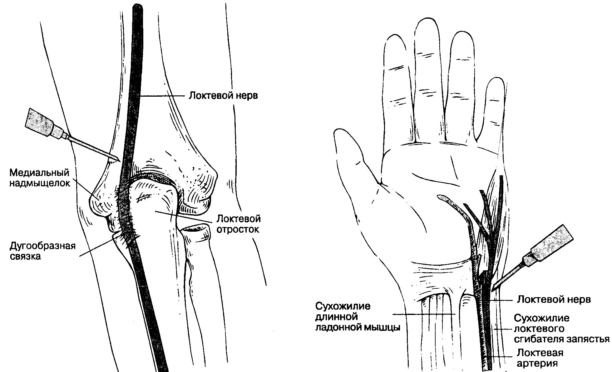 Локтевая невропатия лечение. Проводниковая анестезия локтевого нерва. Блокада локтевого нерва в области локтя. Проводниковая анестезия предплечь. Проводниковая анестезия срединного локтевого и лучевого нервов.